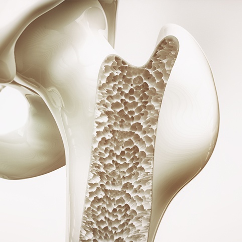 Animated bone structure with osteoarthritis of the hip